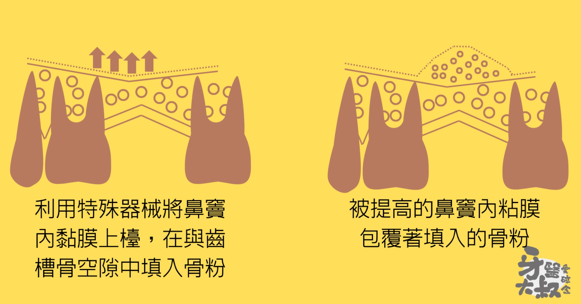 什麼是鼻竇增高術?適合族群、手術流程、風險與費用 什麼是鼻竇增高術?適合族群、手術流程、風險與費用