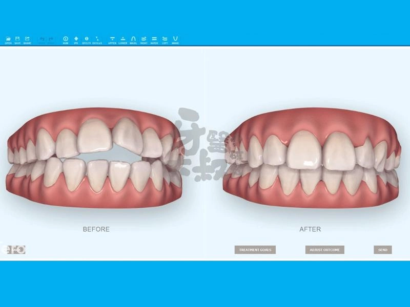 隱適美矯正前的評估有哪些？了解隱適美矯正的評估費用與流程