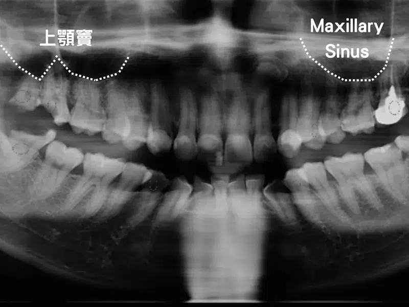 什麼是鼻竇增高術？適合族群、手術流程、風險與費用