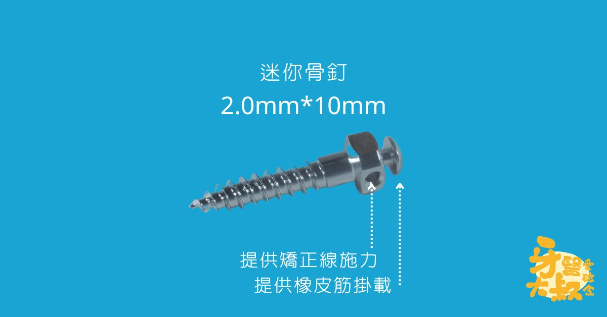 隱適美治療,我該注意什麼?隱適美小叮嚀2:你可能遇到的小裝置 隱適美治療,我該注意什麼?隱適美小叮嚀2:你可能遇到的小裝置