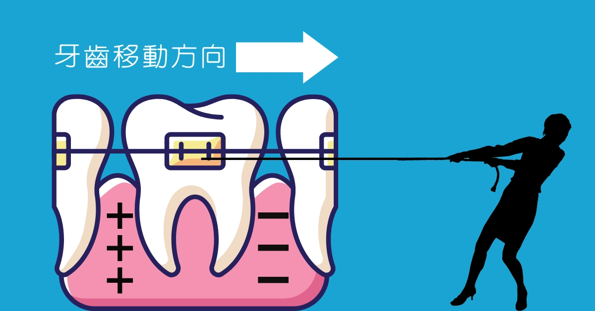 我適合隱適美嗎?與傳統矯正的差別?4類人適合隱適美 我適合隱適美嗎?與傳統矯正的差別?4類人適合隱適美