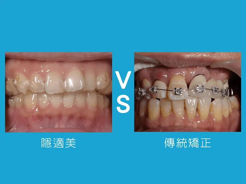 我適合隱適美嗎？與傳統矯正的差別？4類人適合隱適美