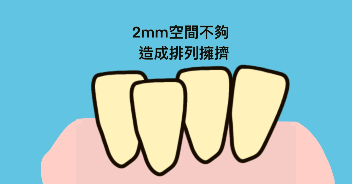 為什麼矯正醫師要修我的牙齒?IPR-牙齒間珐瑯質的寬度調整 為什麼矯正醫師要修我的牙齒?IPR-牙齒間珐瑯質的寬度調整