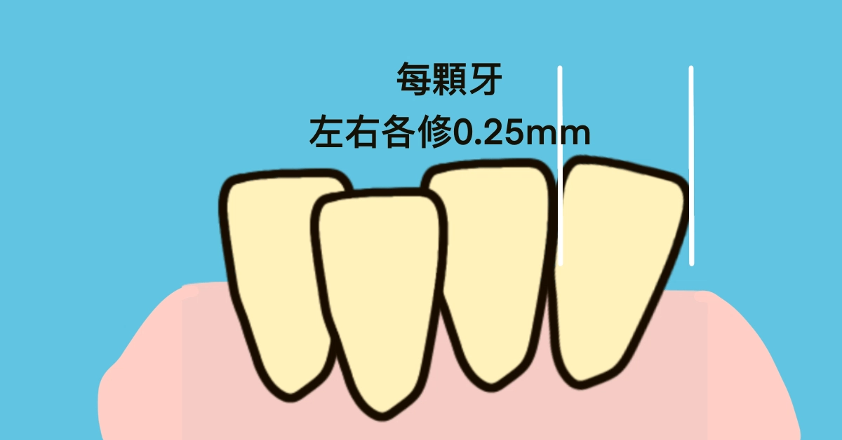 為什麼矯正醫師要修我的牙齒?IPR-牙齒間珐瑯質的寬度調整 為什麼矯正醫師要修我的牙齒?IPR-牙齒間珐瑯質的寬度調整