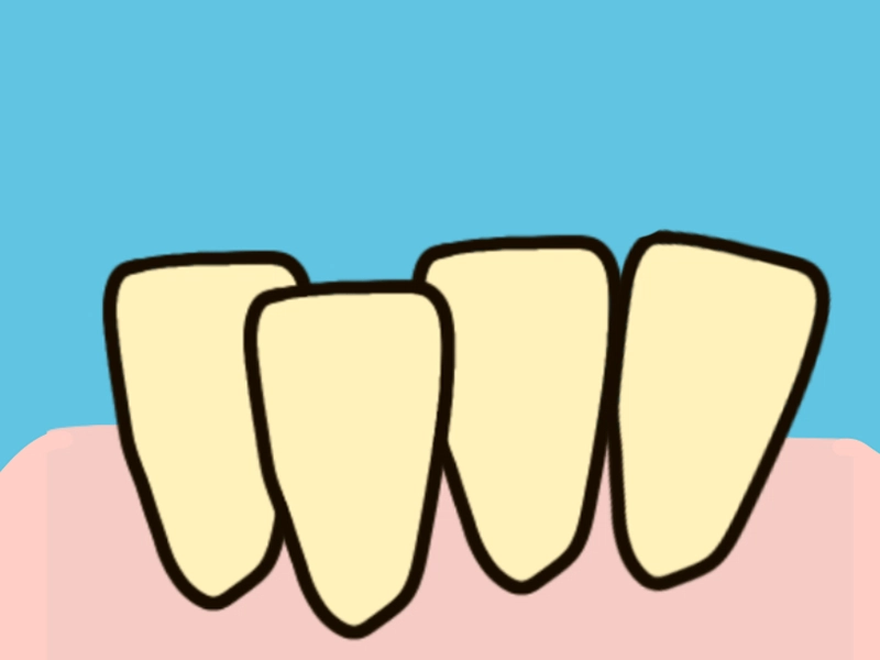 為什麼矯正醫師要修我的牙齒？IPR-牙齒間珐瑯質的寬度調整