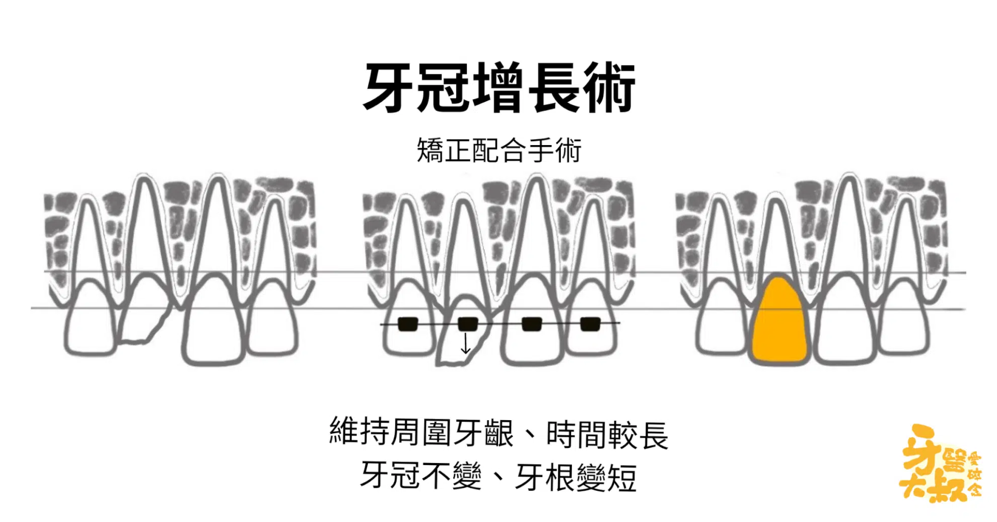 醫師,我牙齒斷了,有救嗎?斷牙怎麼辦 醫師,我牙齒斷了,有救嗎?斷牙怎麼辦