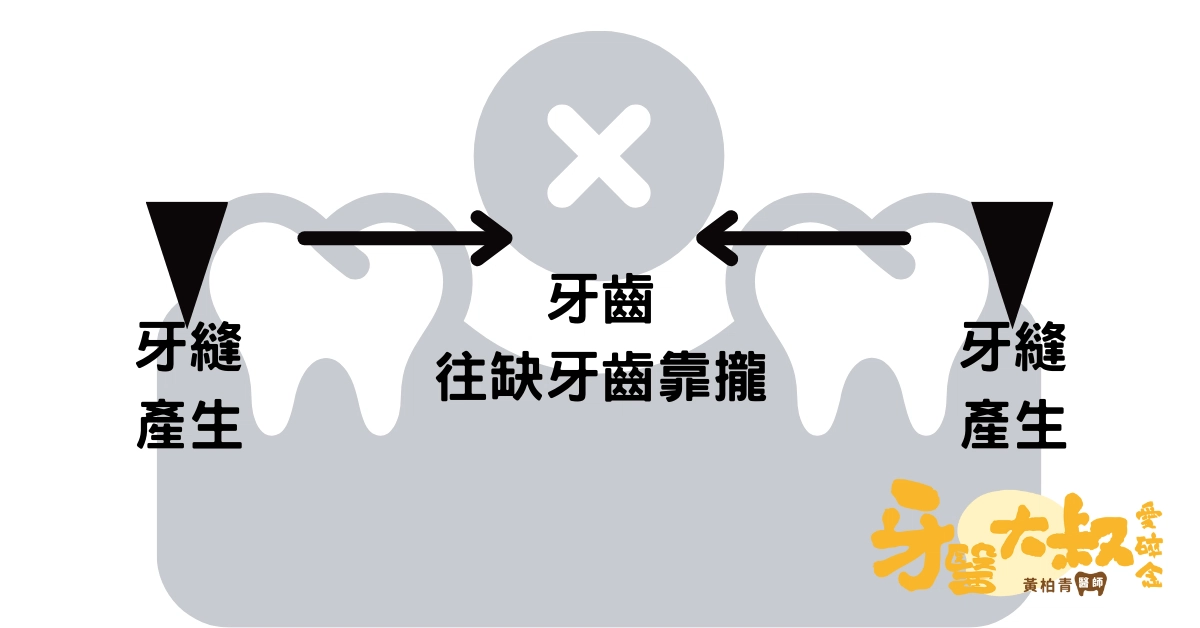 缺牙影響外觀,但植牙好嗎?植牙4大好處與3缺點 缺牙影響外觀,但植牙好嗎?植牙4大好處與3缺點