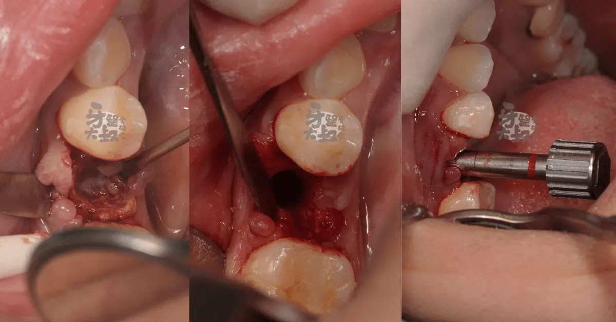 快速搞懂那些植牙名詞：微創植牙、植牙補骨補皮、即拔即植、導板植牙