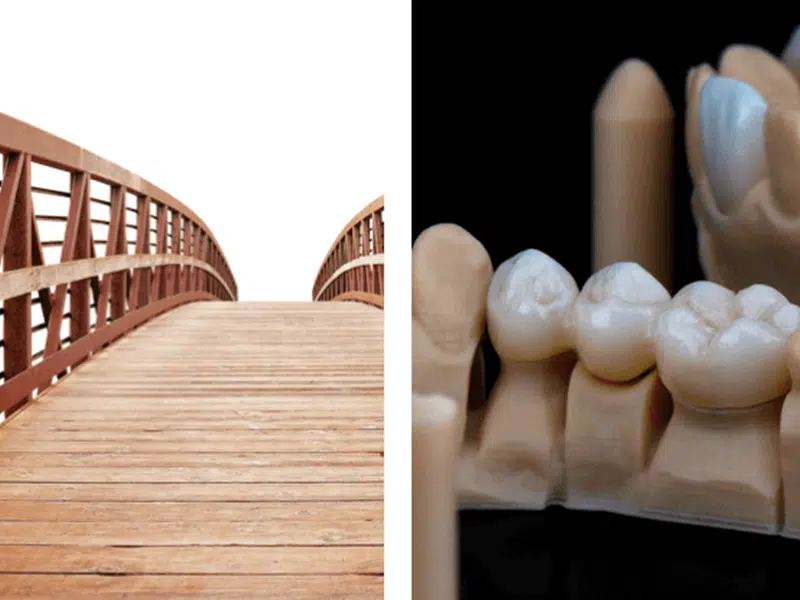缺牙不想植牙？你還有牙橋這個選擇：牙橋禁忌與適應症。