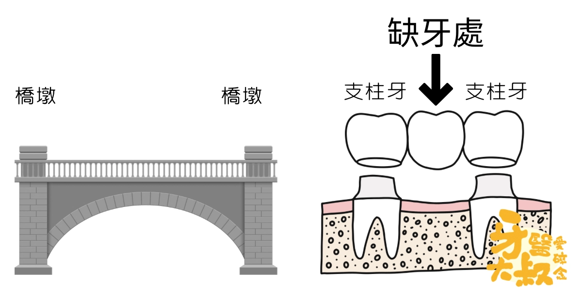 缺牙不想植牙?你還有牙橋這個選擇:牙橋禁忌與適應症。 缺牙不想植牙?你還有牙橋這個選擇:牙橋禁忌與適應症。