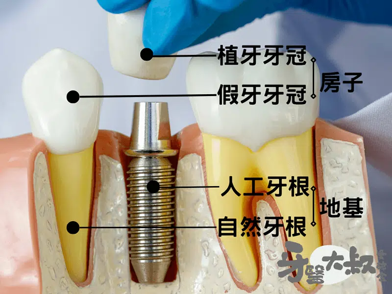 缺牙影響外觀，但植牙好嗎？植牙4大好處與3缺點