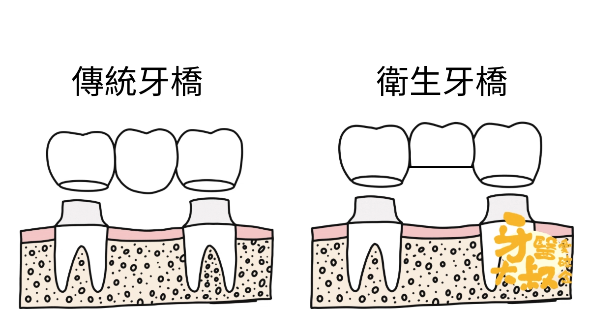 缺牙不想植牙?你還有牙橋這個選擇:牙橋禁忌與適應症。 缺牙不想植牙?你還有牙橋這個選擇:牙橋禁忌與適應症。