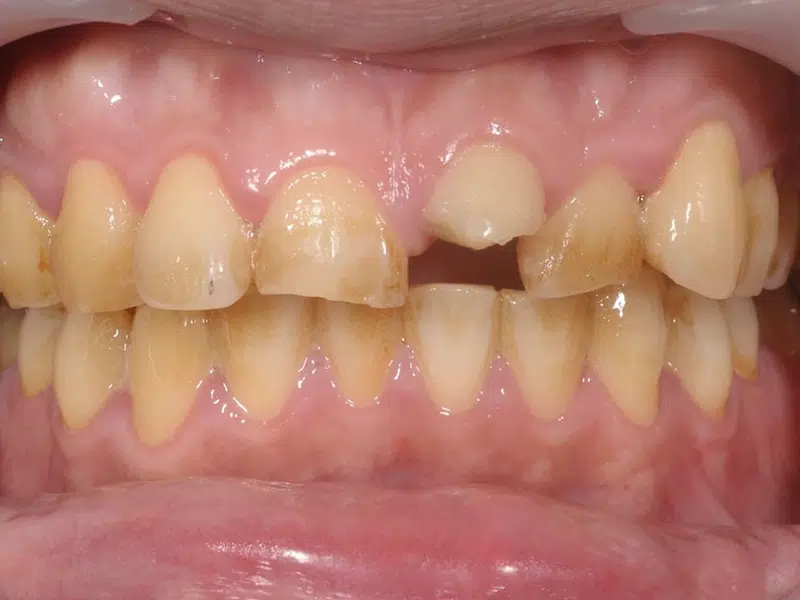 醫師，我牙齒斷了，有救嗎？斷牙怎麼辦