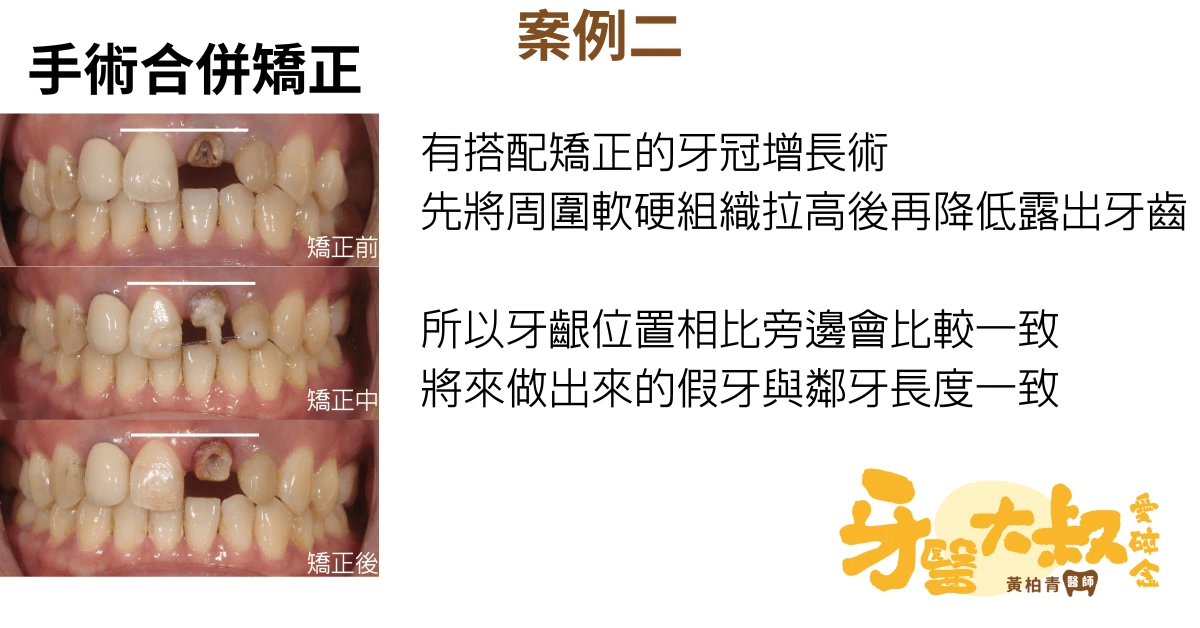醫師,我牙齒斷了,有救嗎?斷牙怎麼辦 醫師,我牙齒斷了,有救嗎?斷牙怎麼辦