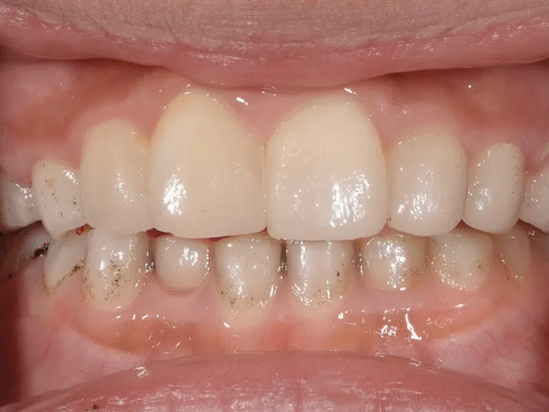 小朋友乳牙上黑黑的是什麼?原來是放線菌啊 小朋友乳牙上黑黑的是什麼?原來是放線菌啊