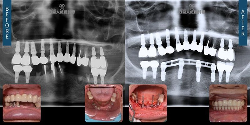 All-on-X, 一日長城